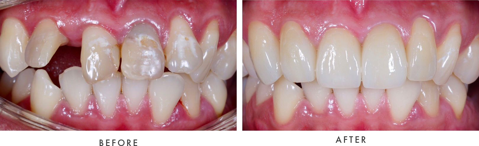 dental implants before & after 002