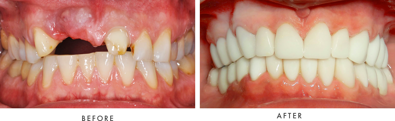 dental implants before & after 003